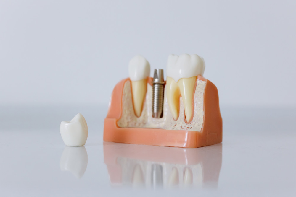 Dental Implants: The Essential Guide to Getting New Teeth – Tooth Treks